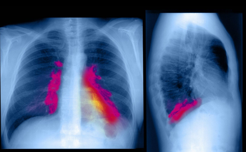 Infección respiratoria del pulmón