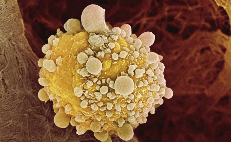 Cellula cancerosa del pancreas