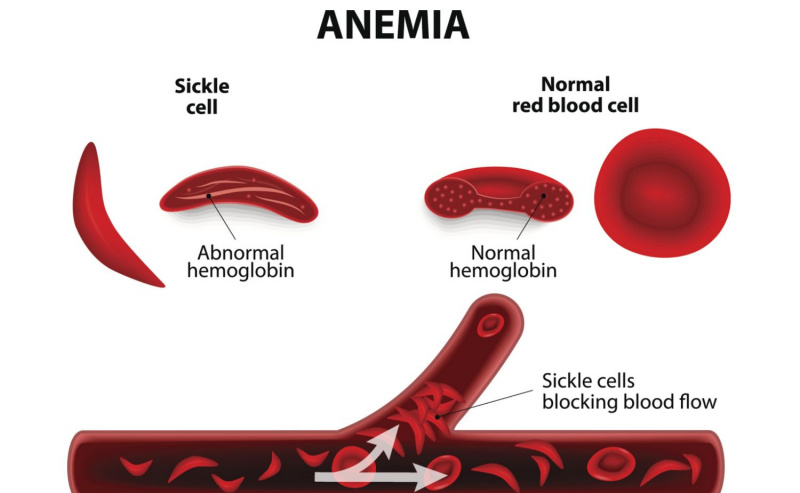 Anemia sierpowata